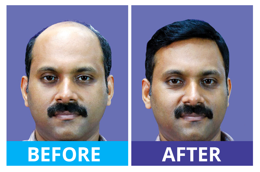 Hairfixing Thrissur - Gateway Hair Fixing