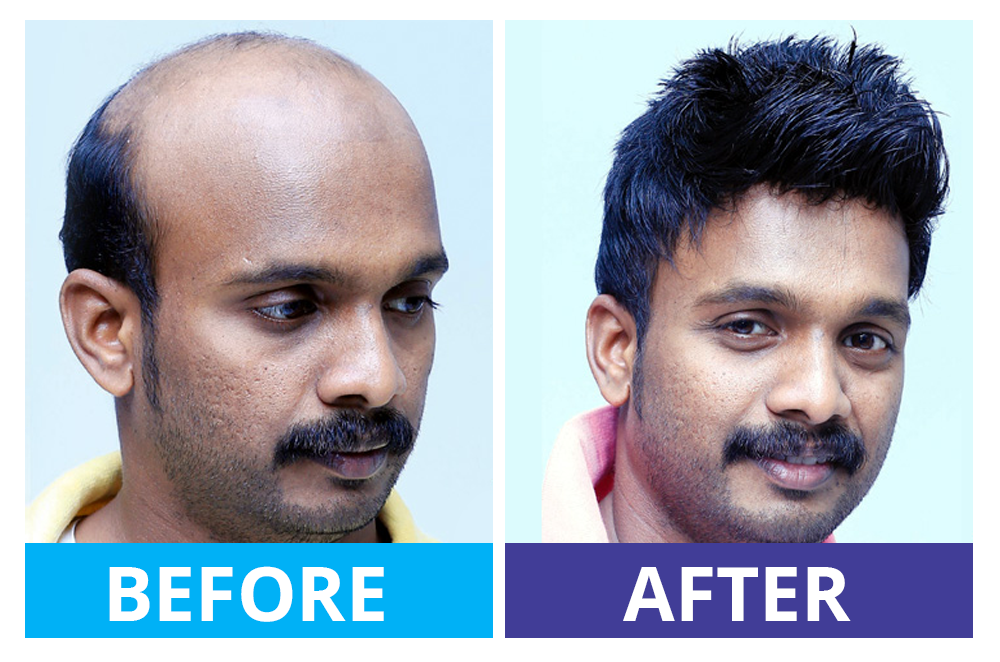 Hairfixing Kannur - Gateway Hair Fixing