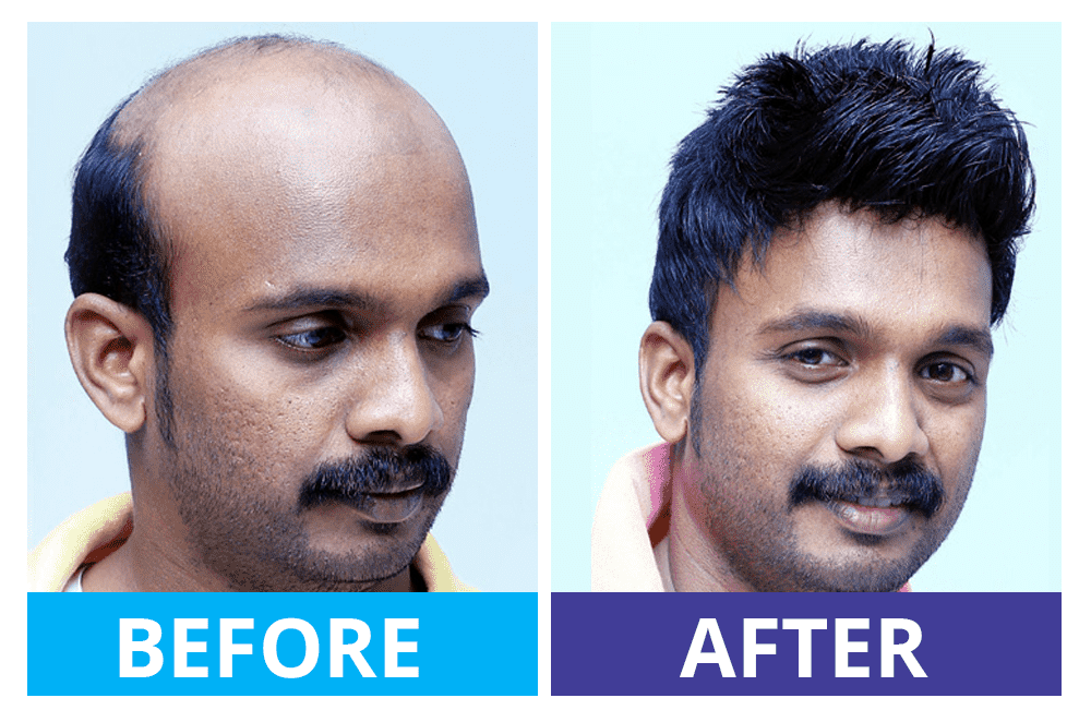 Hairfixing Kerala - Gateway Hair Fixing